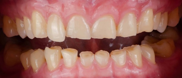 specialist-endodontist-in-surrey