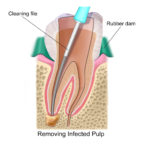 Root Canal Treatment