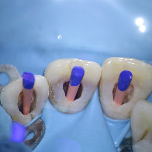 Root Canal Treatment